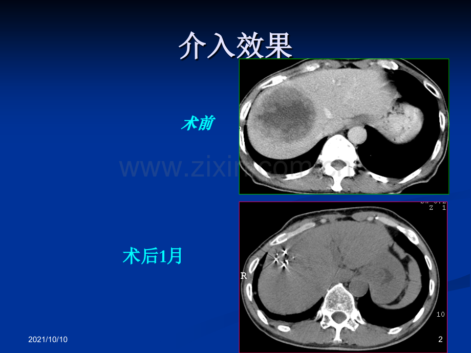 第七章-肿瘤介入及综合治疗.ppt_第2页