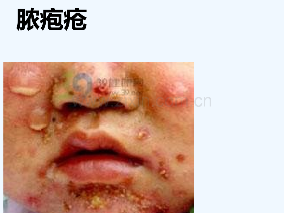 感染性皮肤病病人护理ppt.pptx_第2页