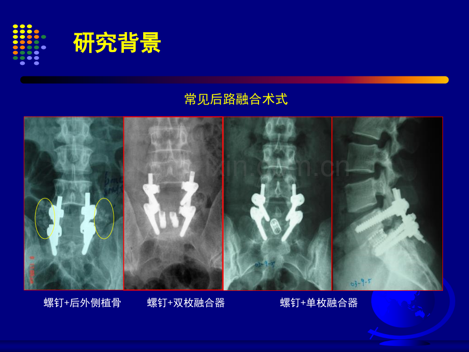 2019年67腰椎滑脱后路不同融合术式的有限元研究.ppt_第2页