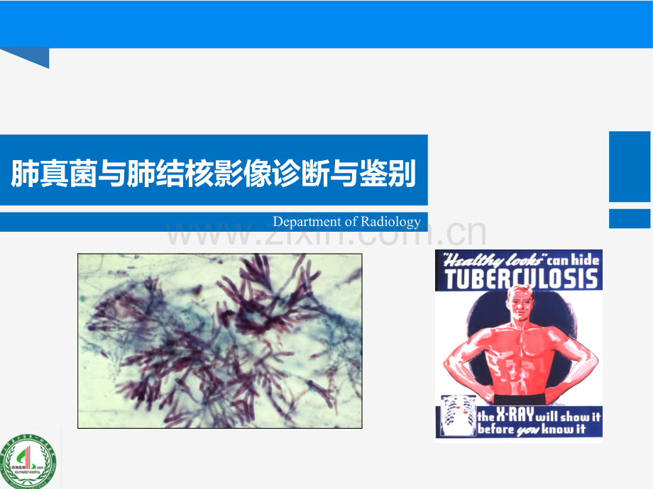 肺部真菌与结核诊断与鉴别诊断.pptx_第1页