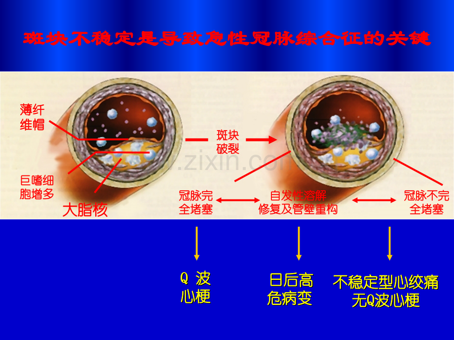 急性心肌梗死.ppt_第2页