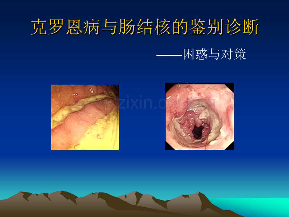 CD与TB的鉴别-.ppt_第1页
