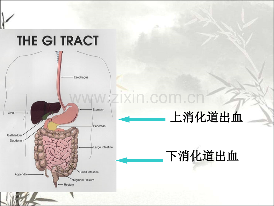 消化道出血的急救与护理ppt.ppt_第2页