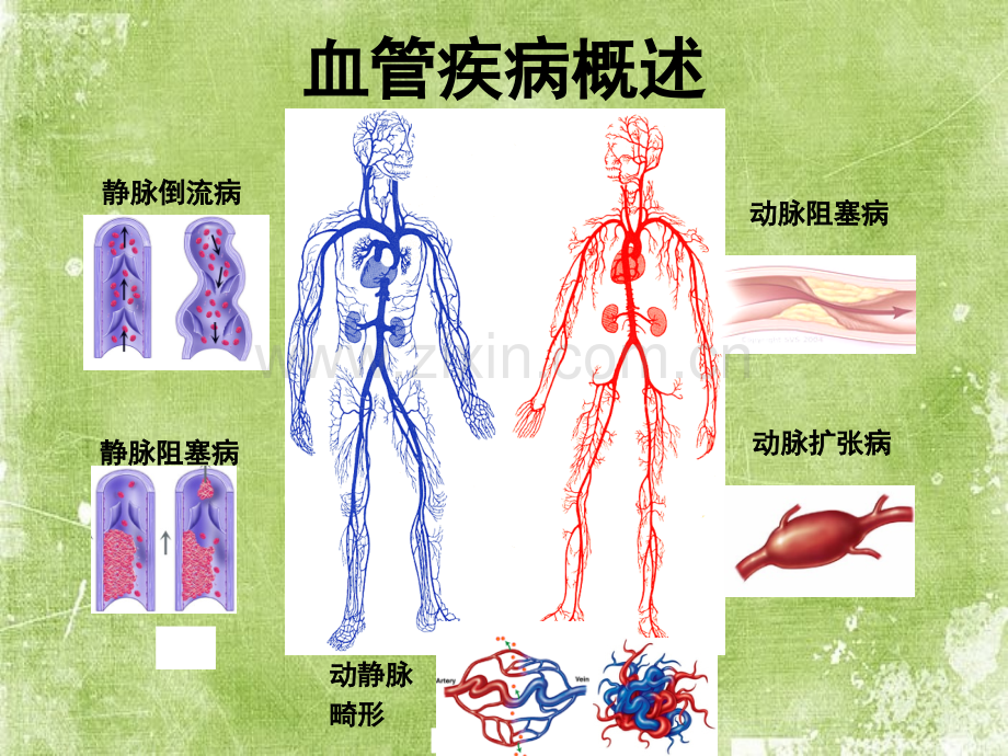 下肢血管疾病ppt.ppt_第2页