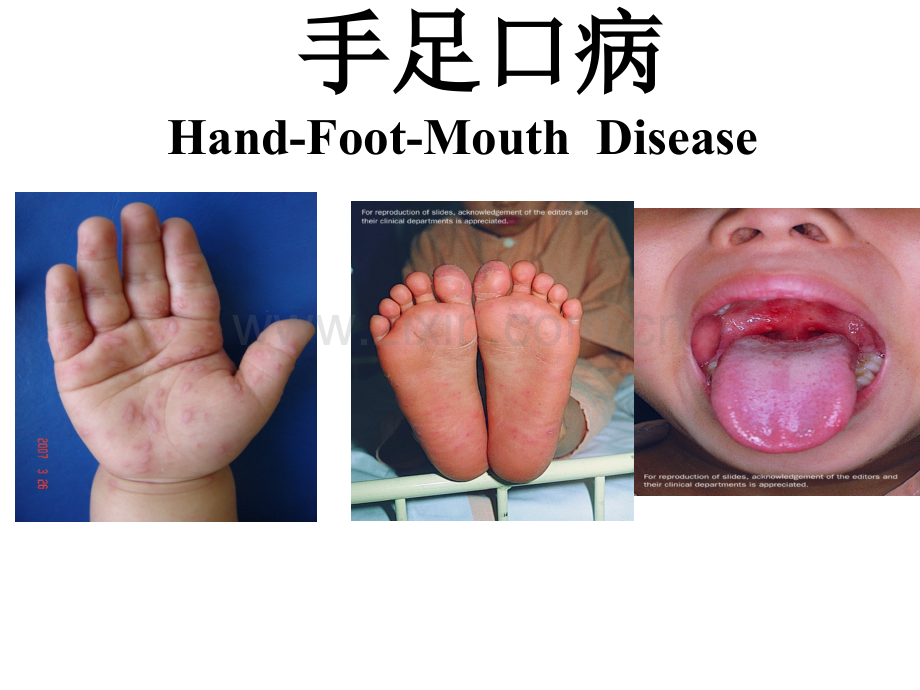 手足口病诊疗指南2018-版解读-PPT.ppt_第1页