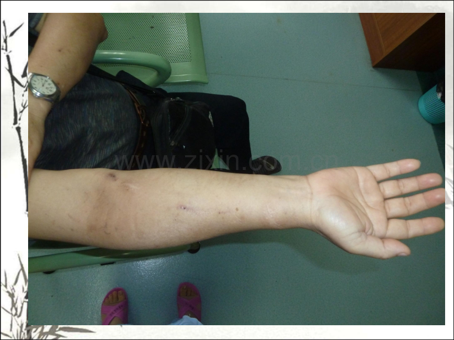 血透患者生命线—动静脉内瘘ppt课件.ppt_第2页