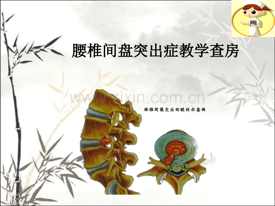 腰椎间盘突出症教学查房ppt课件.ppt_第1页