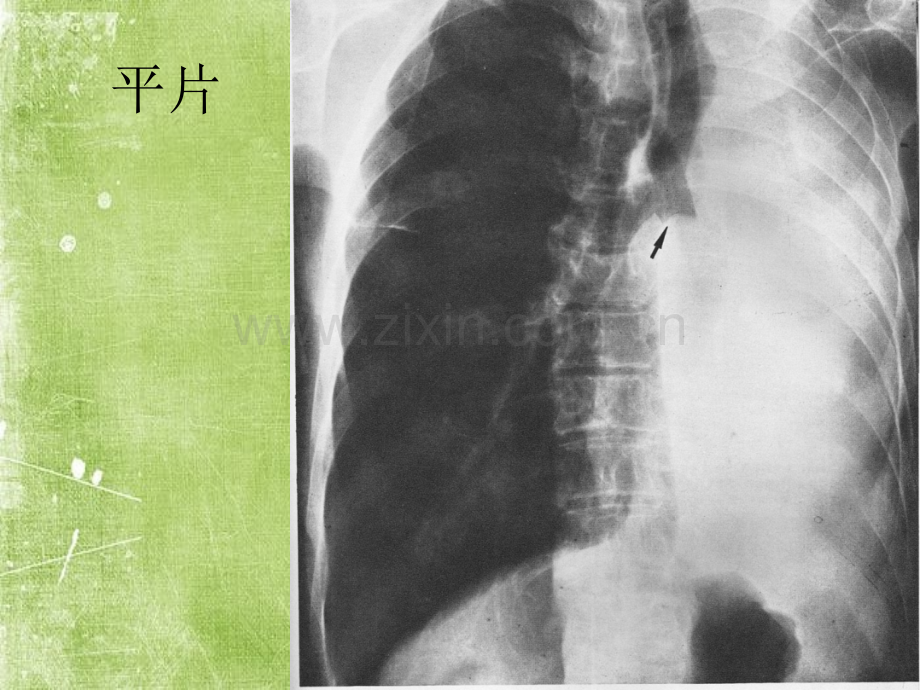 早期肺癌的CT诊断-PPT.ppt_第2页