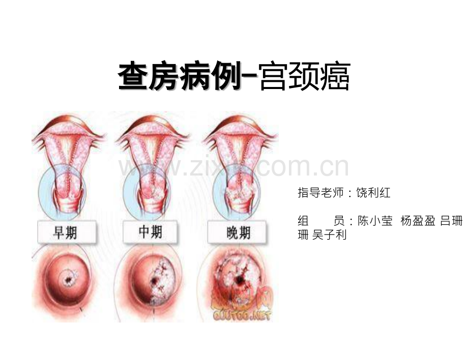 宫颈癌护理查房ppt.ppt_第2页