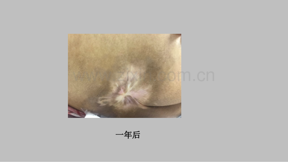 压疮护理.pptx_第2页