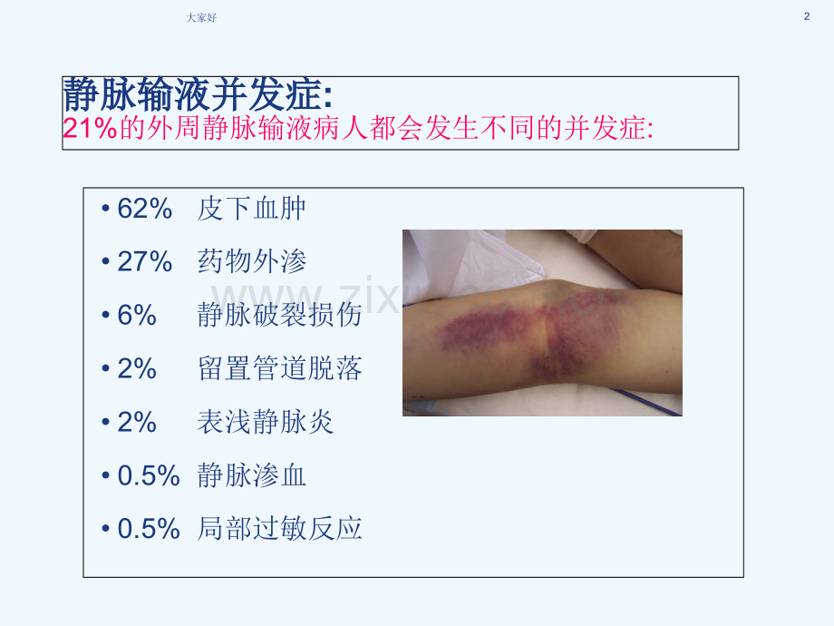 医学课件-静脉炎的预防和处理-PPT.ppt_第2页