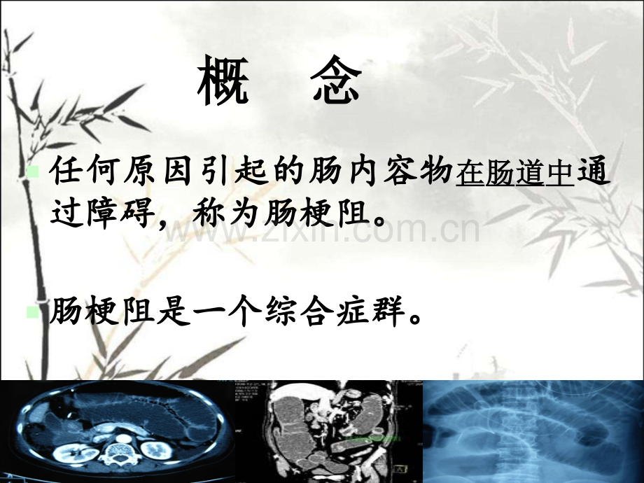 中西医结合治疗肠梗阻及循证证据ppt.ppt_第2页