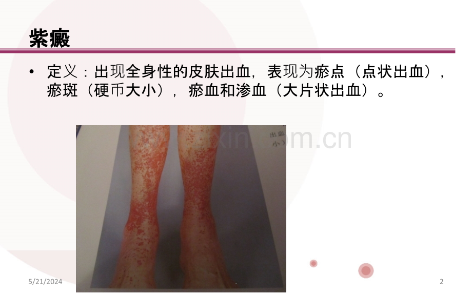 暴发性紫癜诊断及治疗讲义.ppt_第2页