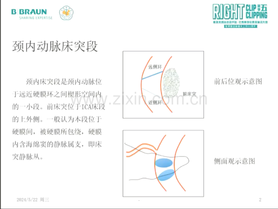 前床突巨大动脉瘤手术夹闭.ppt_第2页