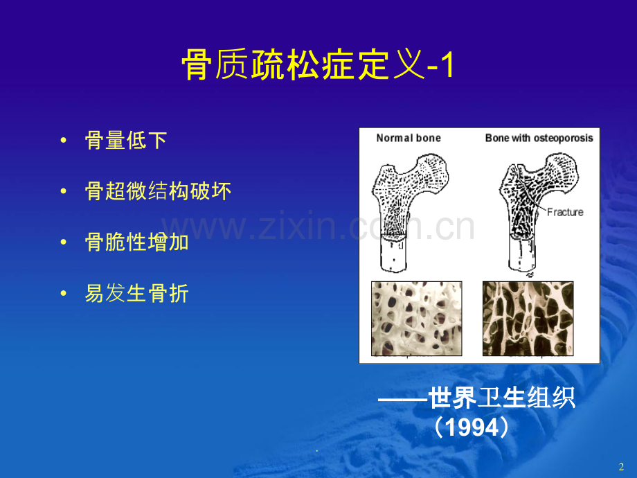李世和骨质疏松诊断与治疗.ppt_第2页