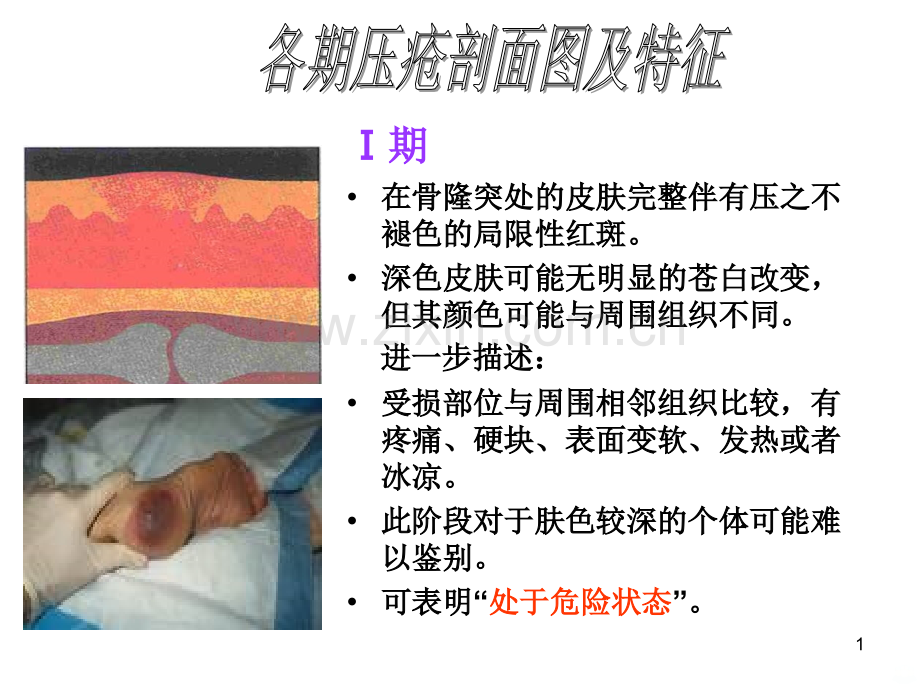 压疮分期图片及文字说明.ppt_第1页