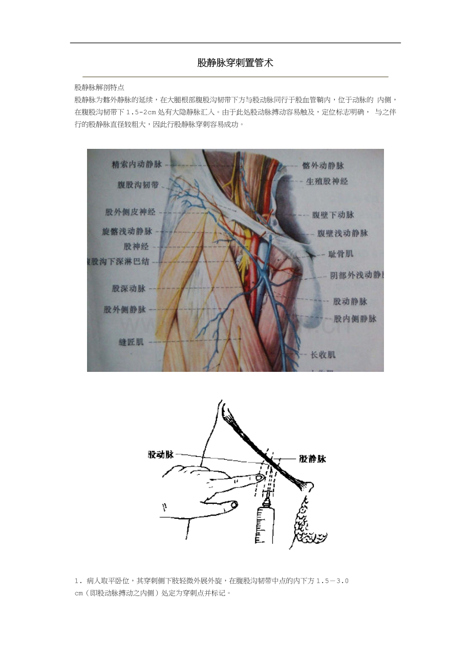 股静脉穿刺置管术.doc_第1页