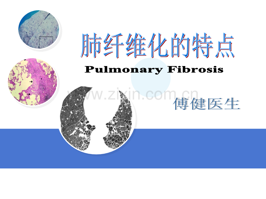 肺纤维化的特点.ppt_第1页