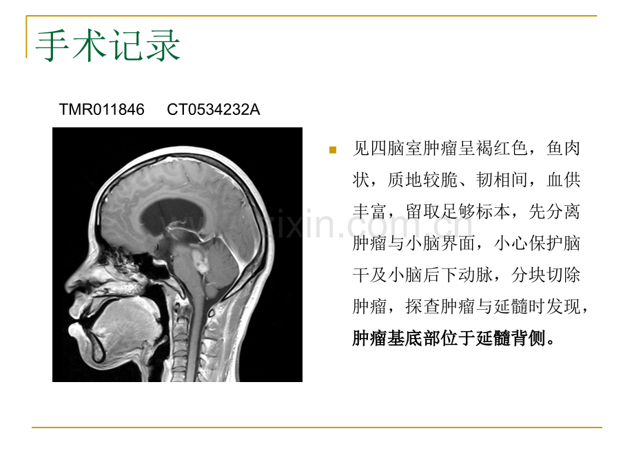 毛细胞型星形细胞瘤诊断与鉴别诊断.ppt_第2页