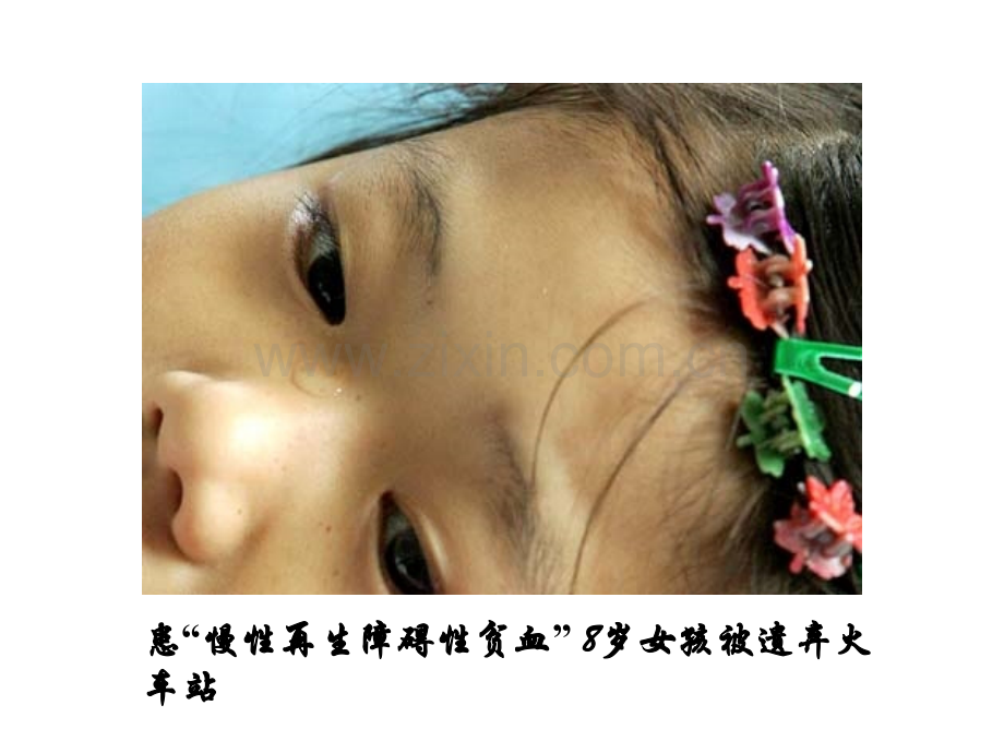 再生障碍性贫血新.ppt_第2页