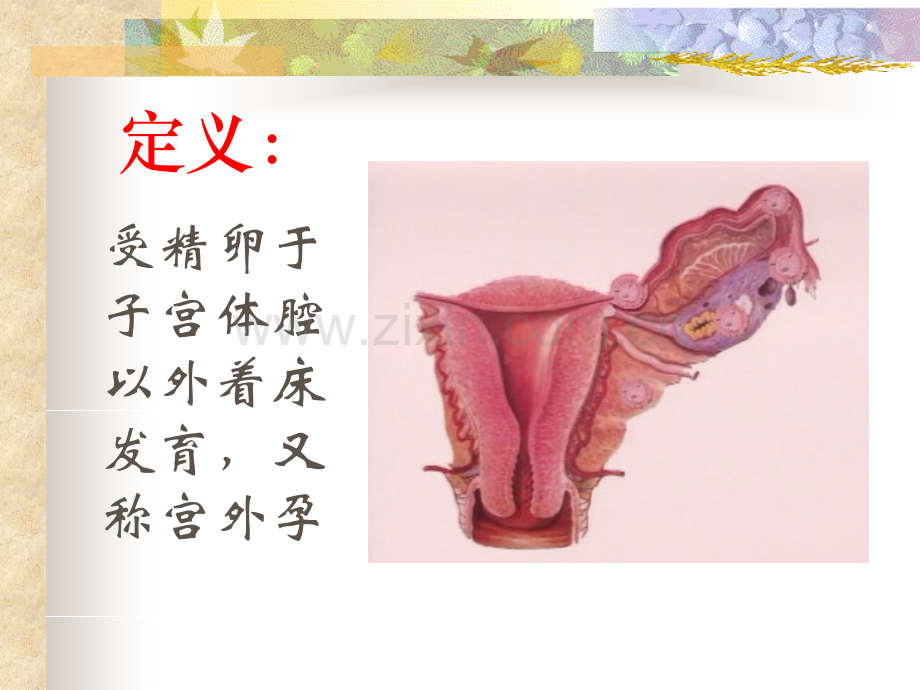 2-宫外孕的护理-PPT课件.ppt_第2页