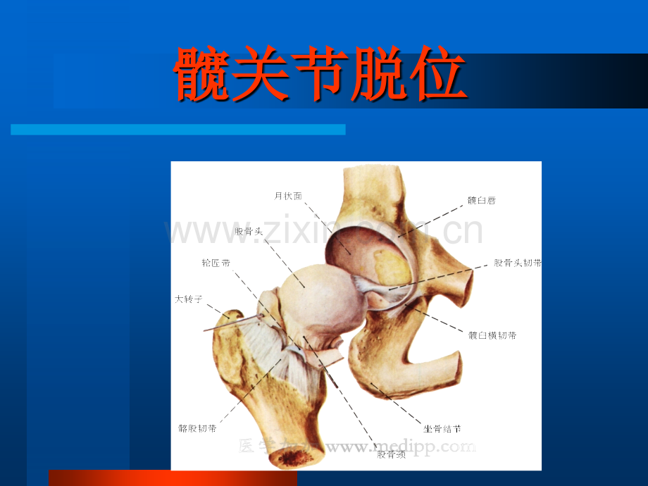 髋关节脱位PPT课件.ppt_第2页