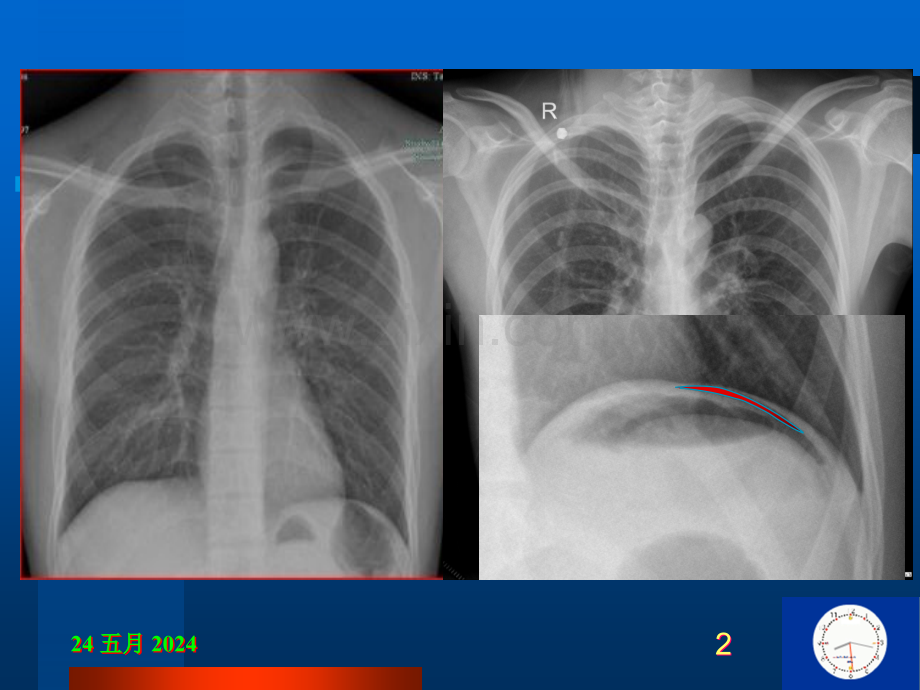 急腹症2胃肠穿孔.ppt_第2页