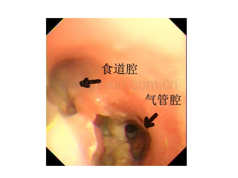 机械通气相关的气管食管瘘.ppt_第2页