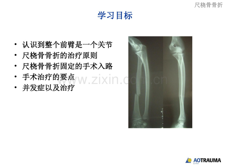 尺桡骨骨折手术原则.pdf_第2页