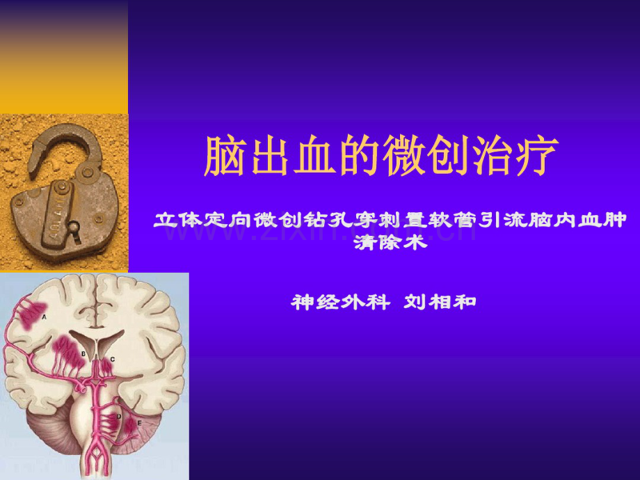 脑出血的微创治疗.pdf_第1页
