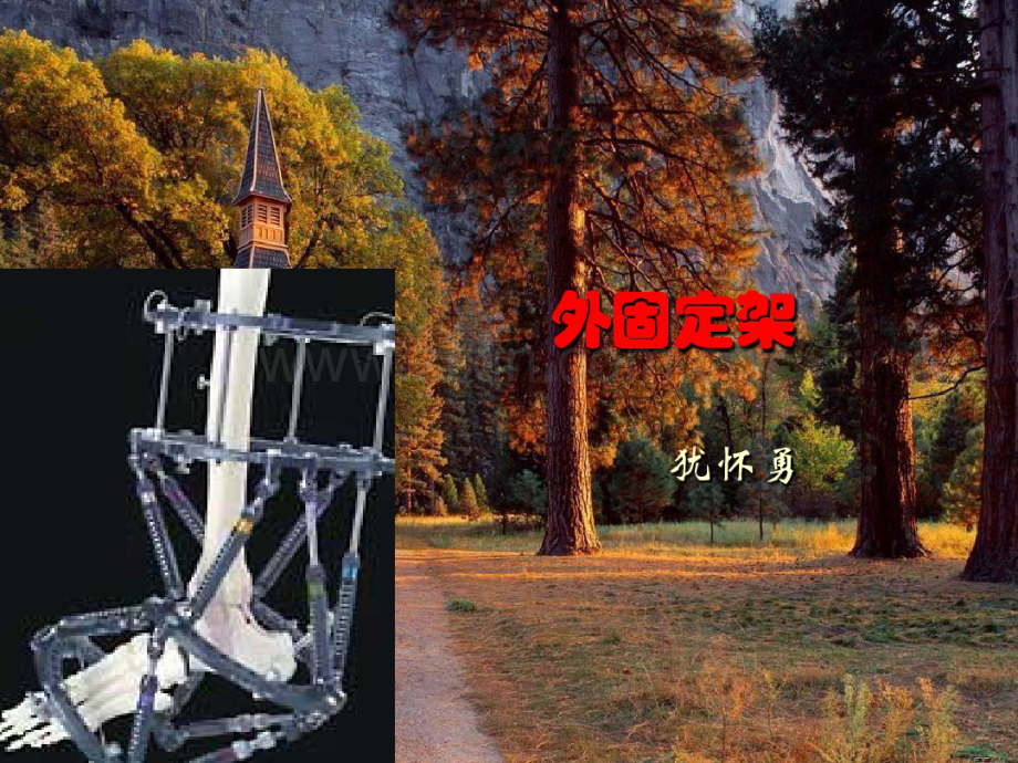 外固定架-(2).pdf_第1页