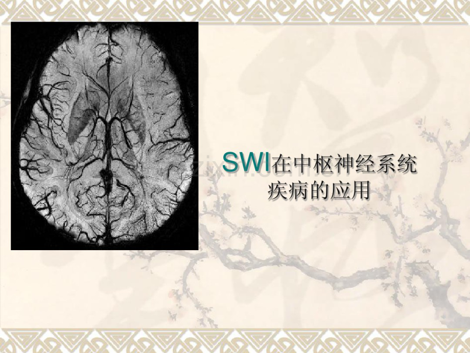 SWI在中枢神经系统应用-(2).pdf_第1页