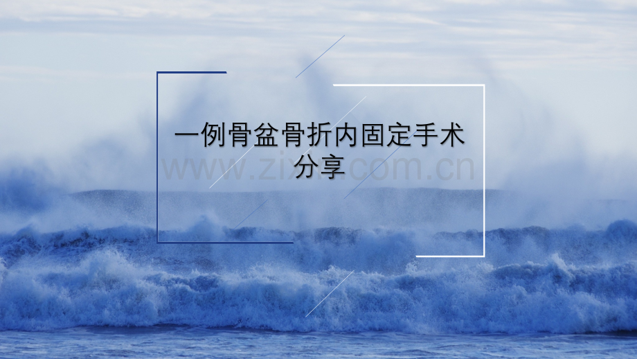 骨盆骨折手术配合.ppt_第1页
