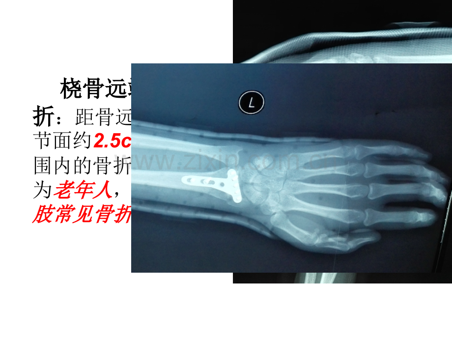 腕关节康复.pptx_第2页