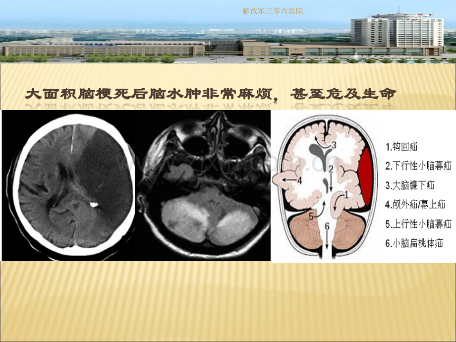 2014年脑梗死后脑水肿管理指南解读.ppt_第2页