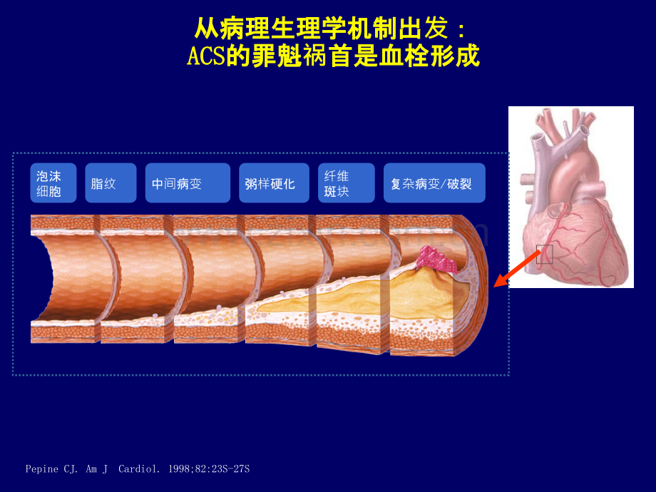 长期抗血小板治疗中需关注的阿司匹林问题.pptx_第2页