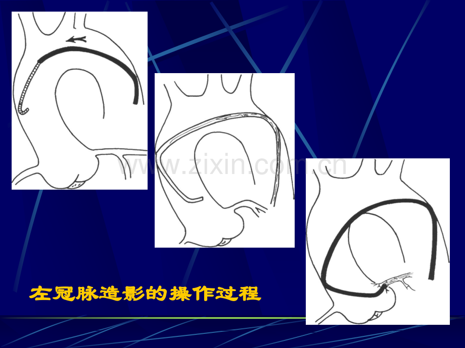 冠脉造影术基础及指引导管选择.ppt_第2页