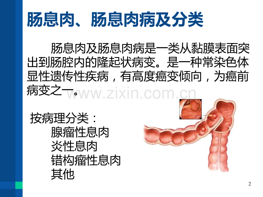 家族性结肠息肉病.ppt_第2页