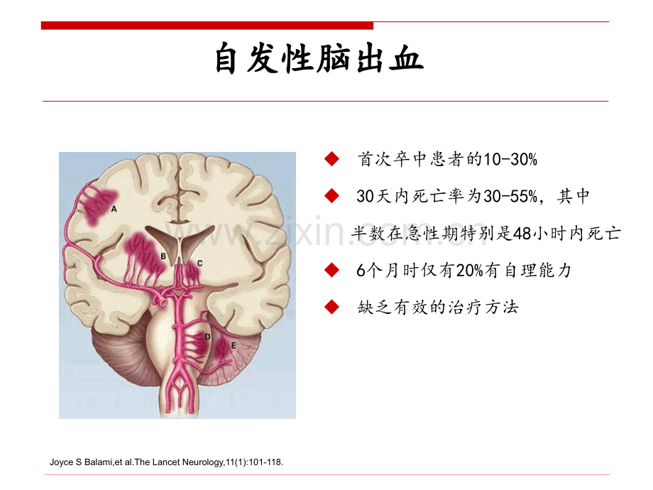 脑出血降压治疗.pptx_第2页
