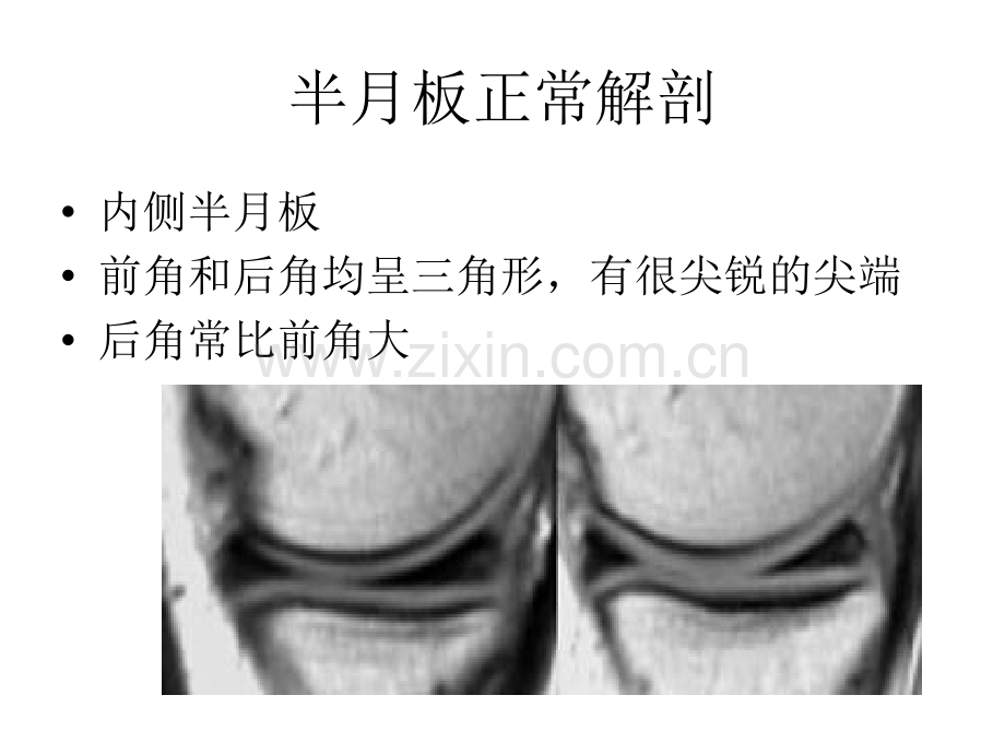 半月板的影像学表现分析演示课件.ppt_第2页
