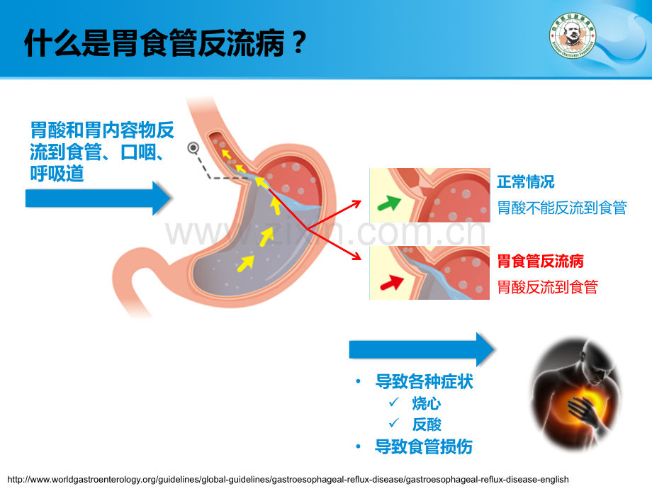 胃食管反流病患者的生活小贴士.ppt_第2页