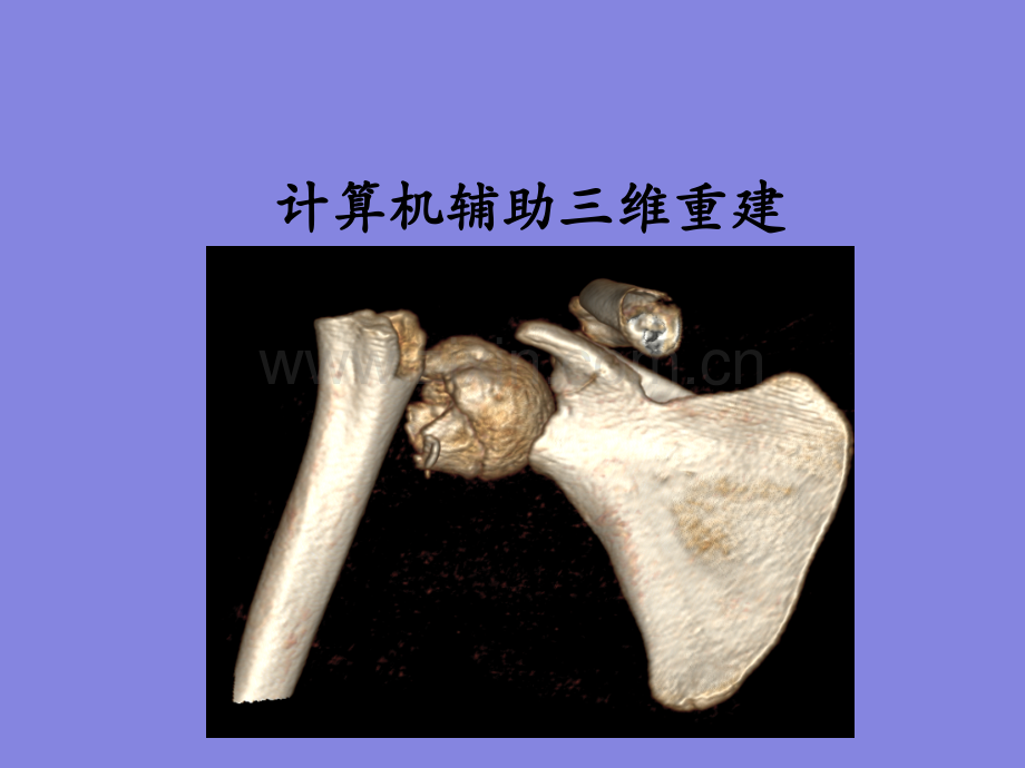 3D打印在骨科的应用.ppt_第2页
