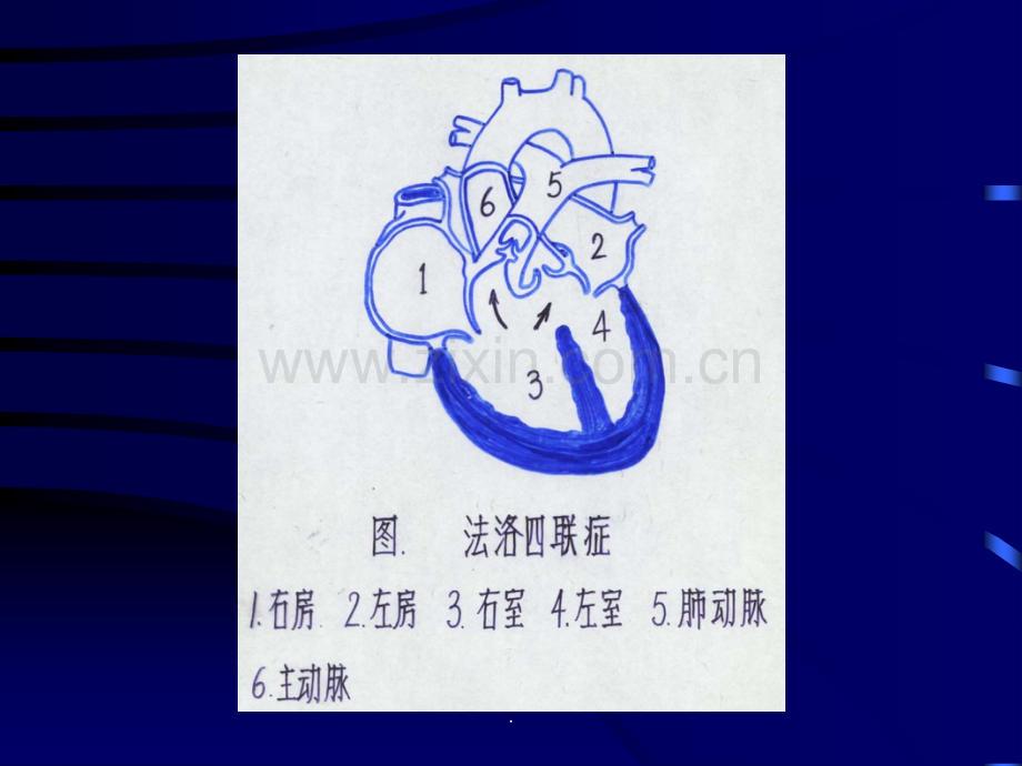 法洛四联症(TOF).ppt_第2页