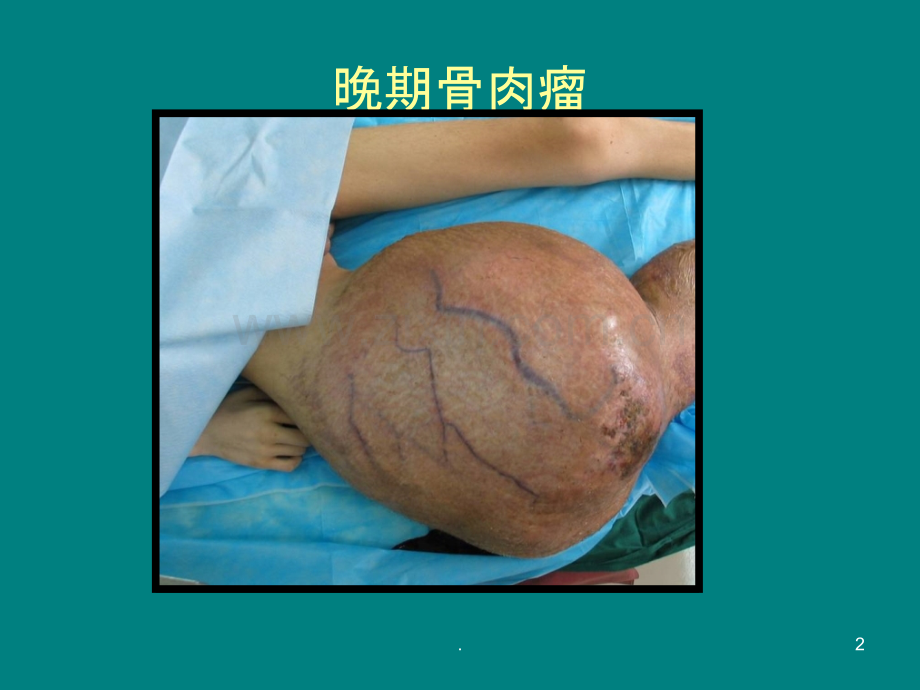 骨肉瘤的规范化治疗ppt课件.ppt_第2页