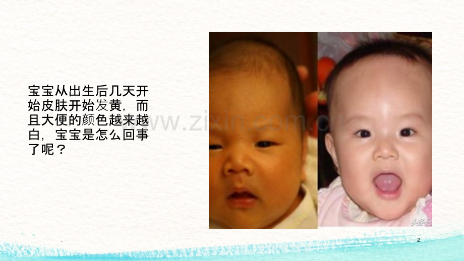 胆道闭锁患儿的护理.ppt_第2页