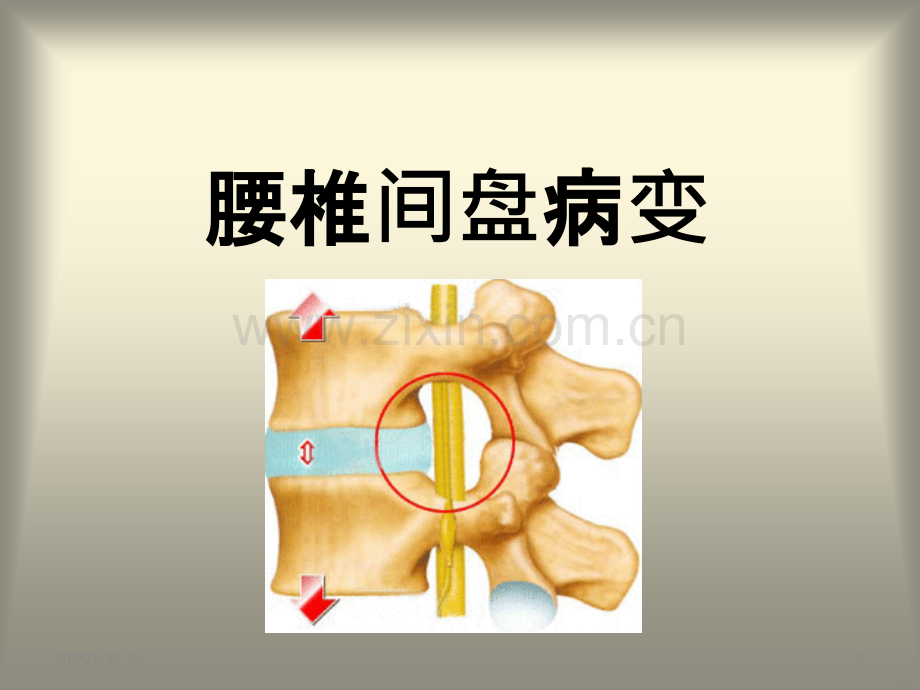 腰椎间盘病变的分型和影像学诊断.ppt_第2页
