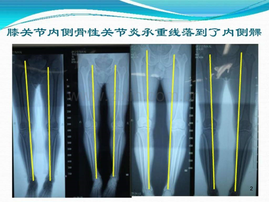 骨性关节炎的诊断-临床医学-医药卫生-专业资料ppt课件.ppt_第2页