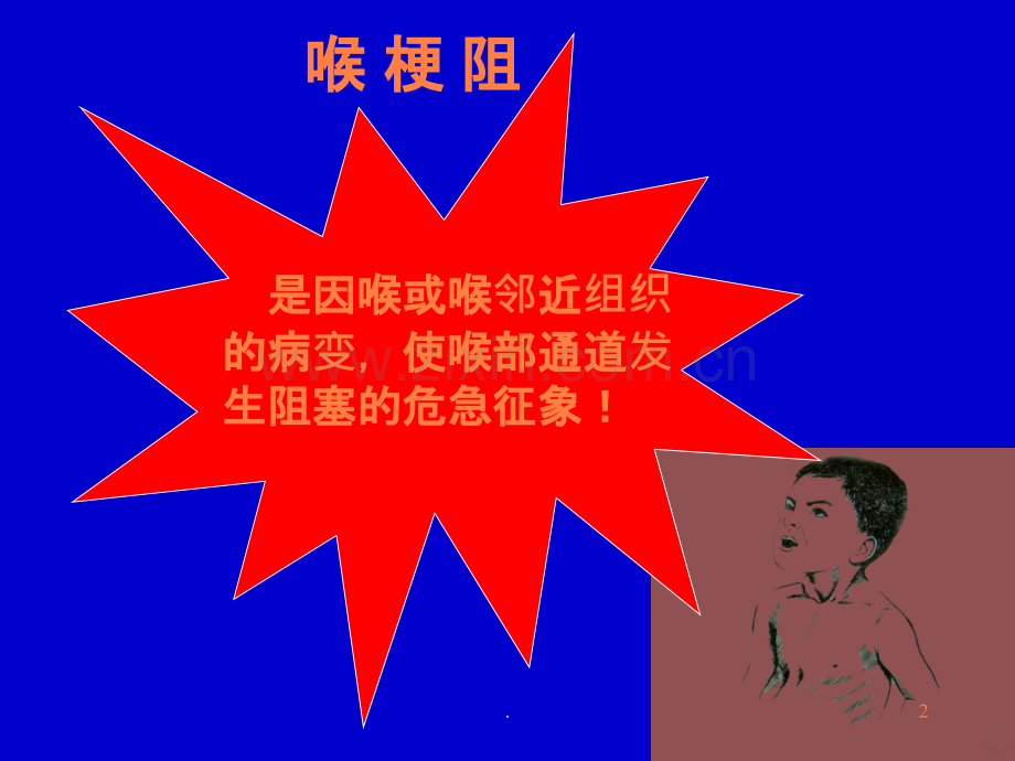 喉梗阻教学ppt课件.ppt_第2页