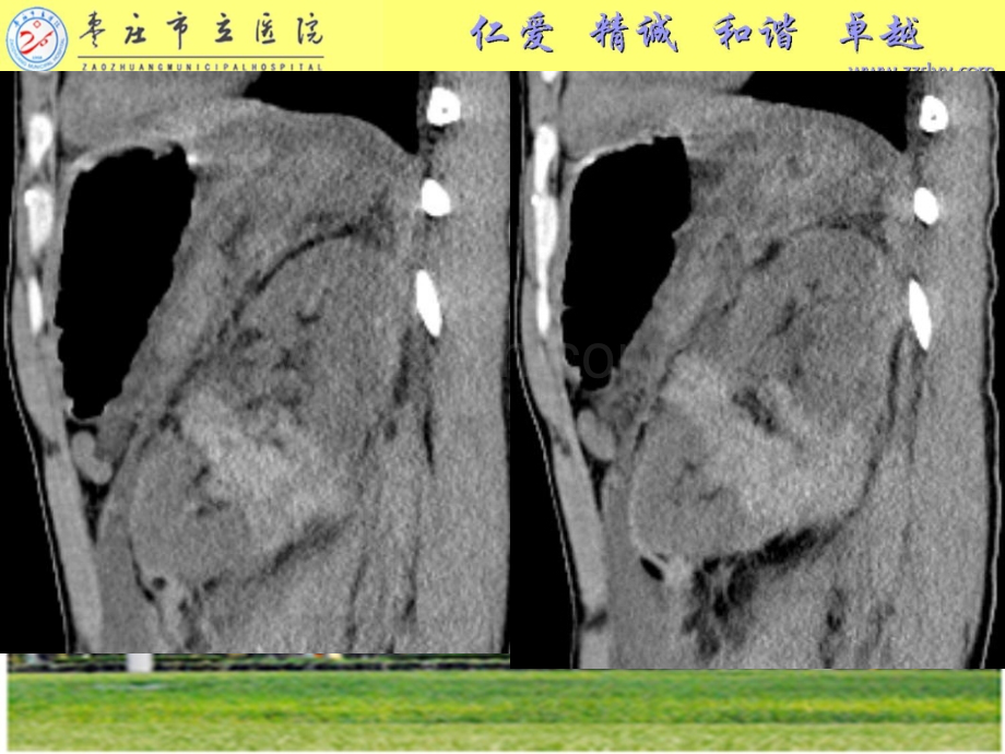 肾脏损伤分级.ppt_第2页