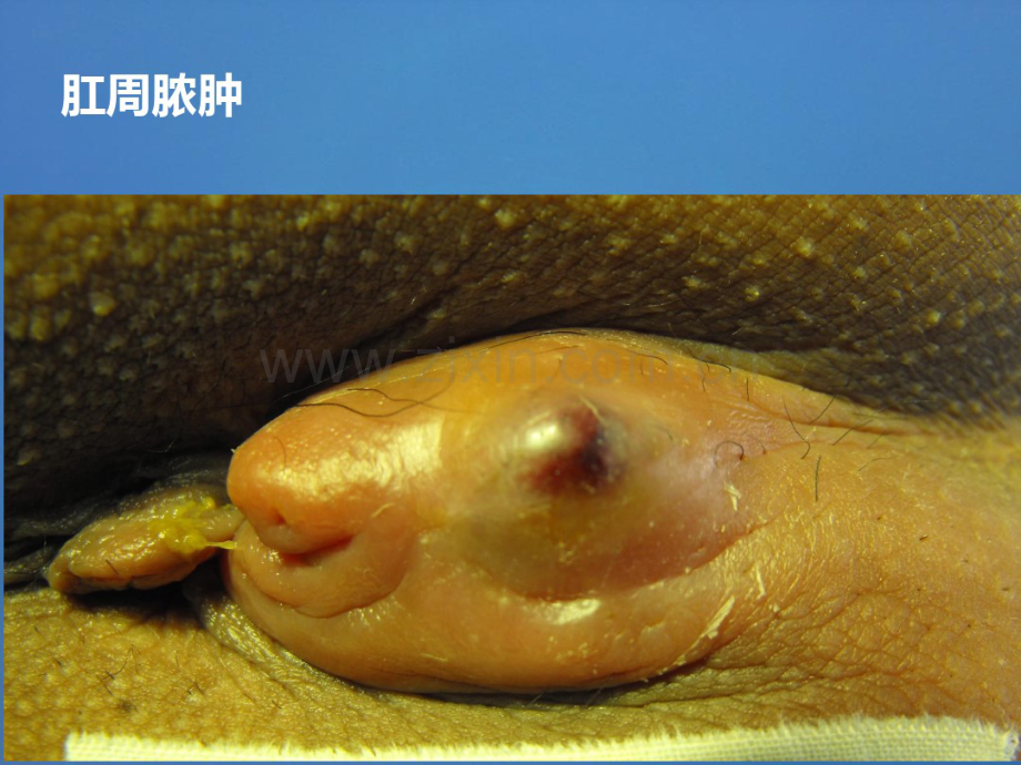 肛周脓肿.pdf_第1页